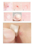 Face Acne Pimple Spot Scar Care Treatment Stickers