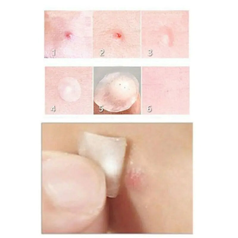 Face Acne Pimple Spot Scar Care Treatment Stickers