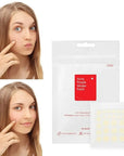 Face Acne Pimple Spot Scar Care Treatment Stickers